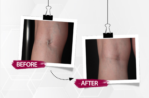 Diskon 10% untuk Varices Treat...